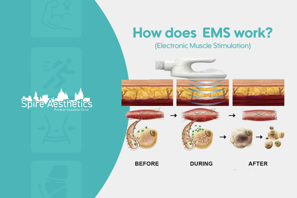 EMS treatment for post pregnancy weight loss treatment Rotherham
