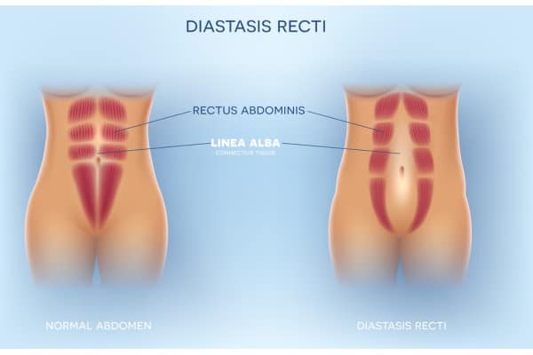 What Non-Surgical Options Are Available for Diastasis Recti Rotherham?