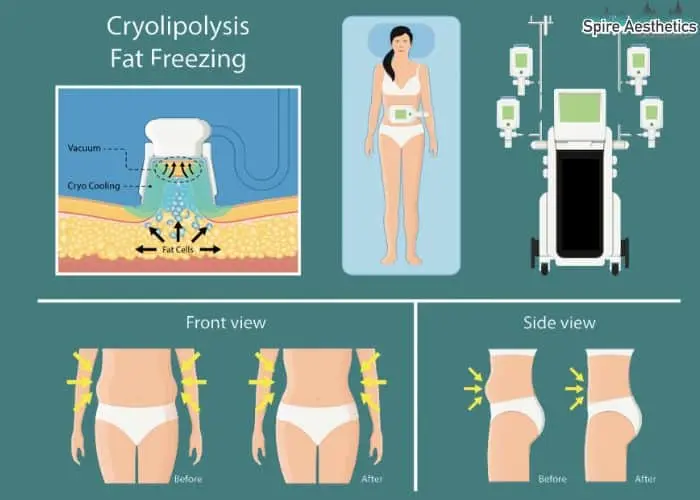 Fat freezing treatment Rotherham benefits for competitions to remove stubborn fat deposits.