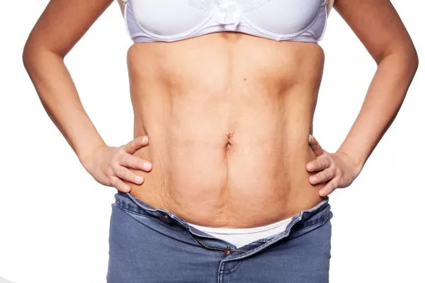 sagging skin on woman's stomach after weight loss injections Rotherham