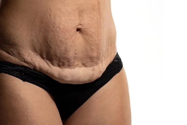 Image of womans stomach after weight loss injections Rotherham showing saggy skin