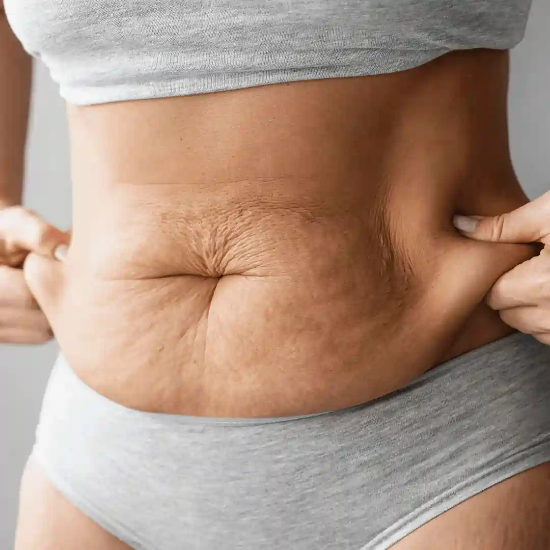 Is It Normal to Have Loose Skin After Pregnancy Rotherham?