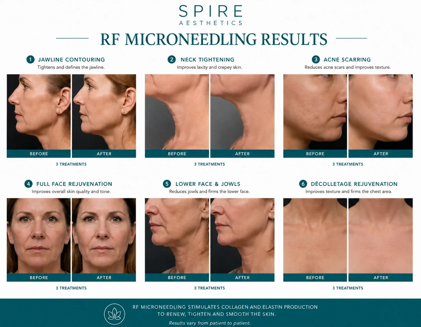 RF Microneedling Skin tightening Rotherham results