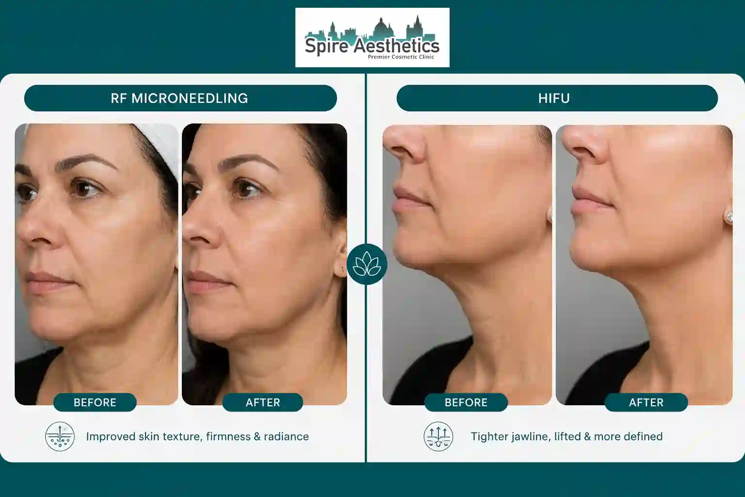 Can RF Microneedling and HIFU Be Combined Rotherham?