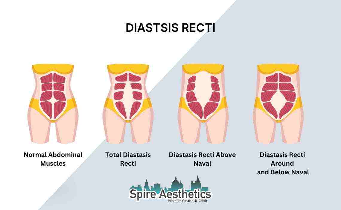 Is Non-Surgical Diastasis Recti Treatment Right for You? Common Concerns Answered Rotherham